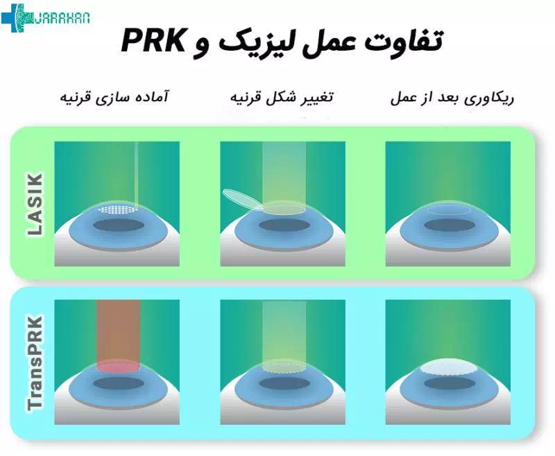 تفاوت عمل PRK و لیزیک